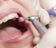 Teeth cleaning and lime removal + treatment plan for 129 riyals